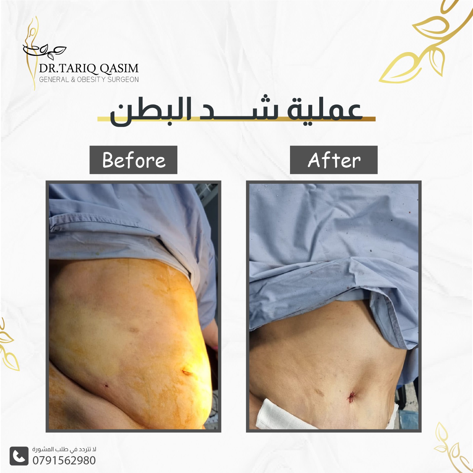 جراحات السمنة بخبرة طبية مدعومة بحلول TajPay